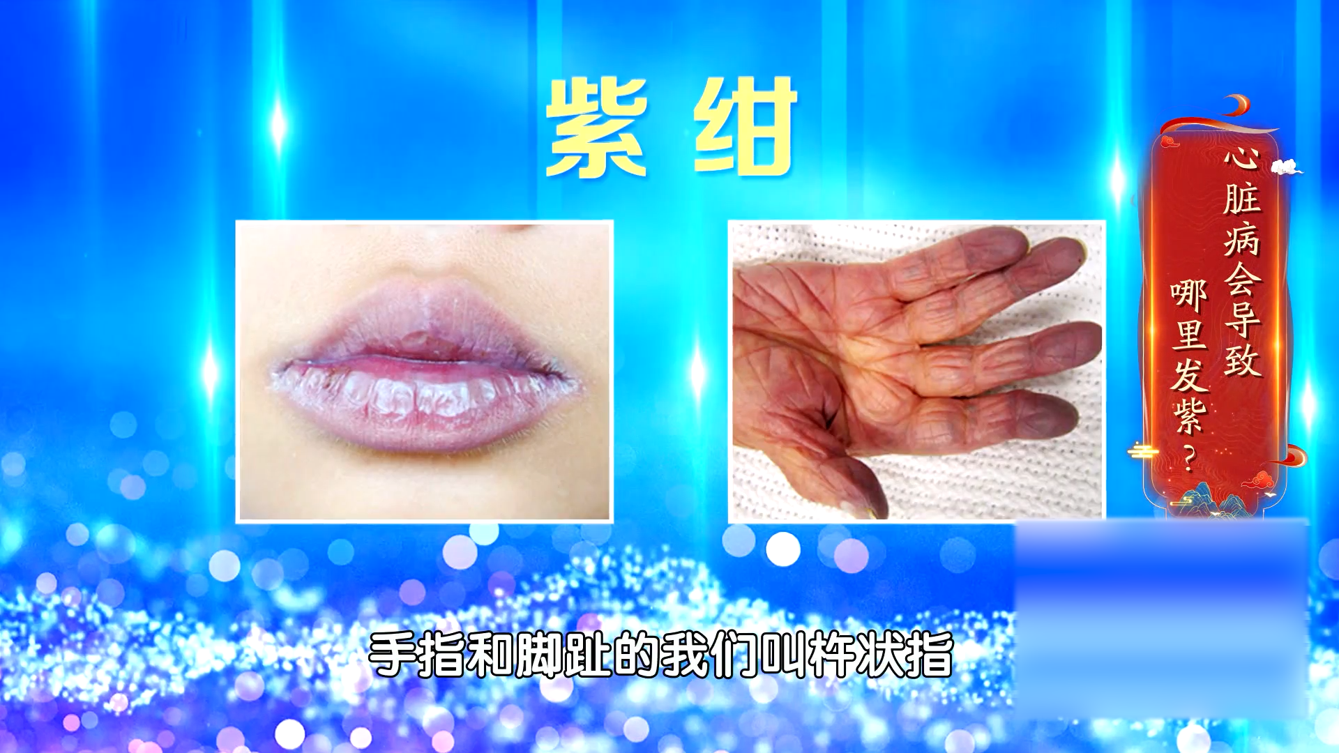 一种特别的累、两个部位的紫绀，可能是心脏病！快查超声心动图