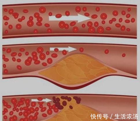 35岁后要多吃1种蔬菜,可以疏通甘油三酯,降血