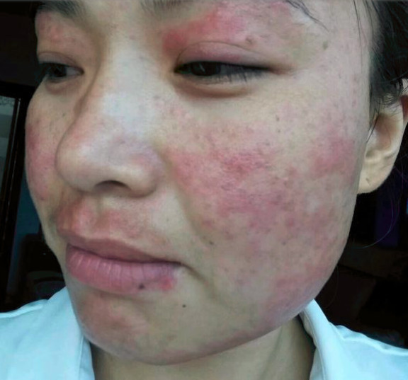 脸过敏性湿疹怎么办?小偏方极速解决湿疹烦恼