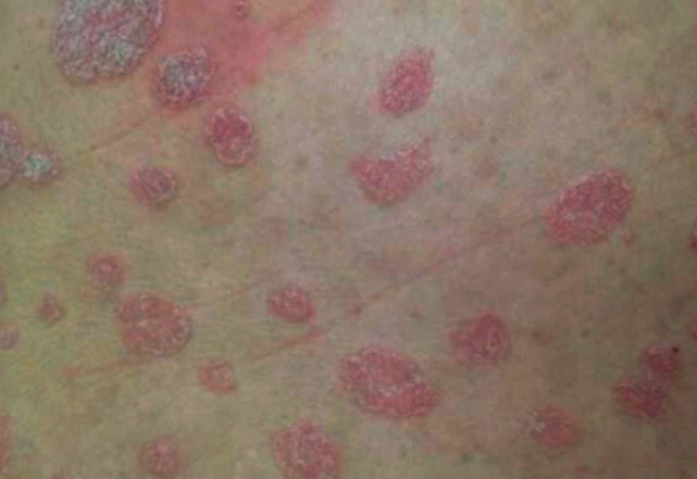 如何治疗铜钱癣?最正确的治疗姿势你学会了吗