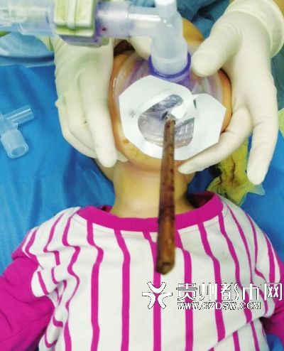 一岁男孩吃粽子摔倒 麻醉师在朋友圈发出血的