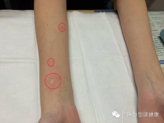 过敏性鼻炎真是不治之症?你的认识需要更新了