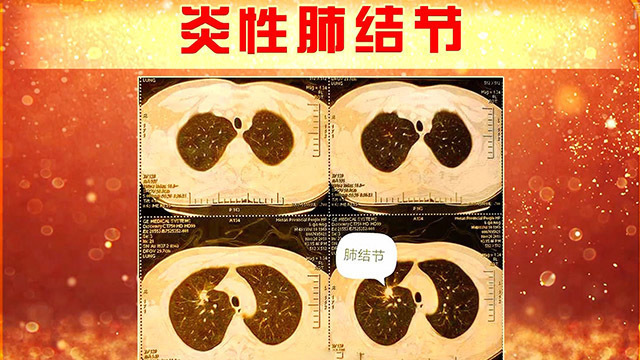 造成肺炎的原因是热毒 听听专家怎么说_北京时间