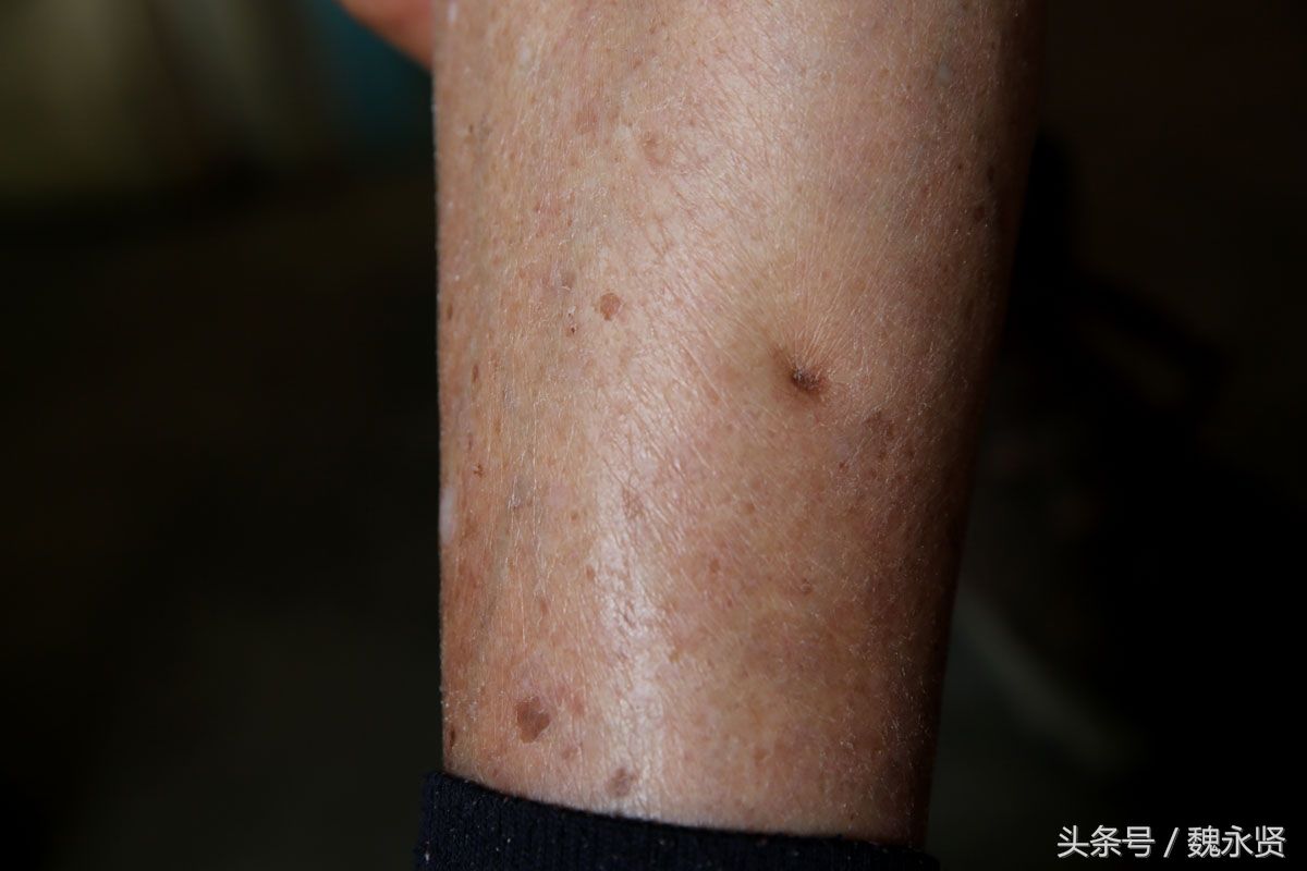 被弹片炸伤的腿.