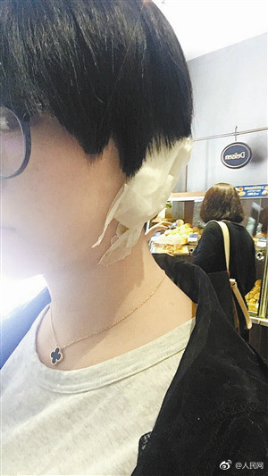 女子理发被剪下耳垂 店员:剪掉很正常 女子理发被剪下耳垂 店员:剪掉很正常