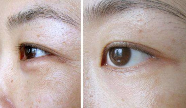 美容院打死不说的药膏:每晚擦一点,虽便宜但用后,眼袋眼纹消失