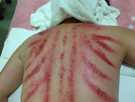 酵素足贴:体内湿气过重,老中医教你5天去湿恢