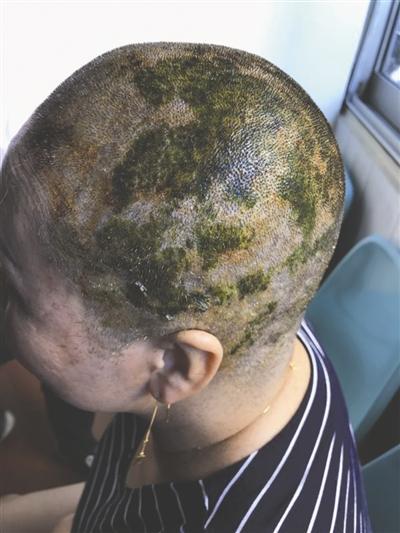 女子7小时连续染发4次 头皮烧伤休克住院5天 女子7小时连续染发4次 头皮烧伤休克住院5天