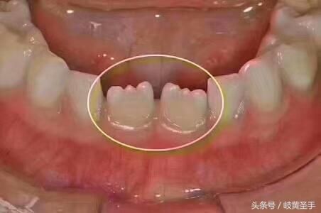 科普:小孩新换的牙齿,为什么呈锯齿状?