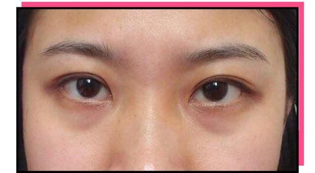 黑眼圈,眼袋用眼霜有用吗?一篇文章帮你搞定黑眼圈所有问题!