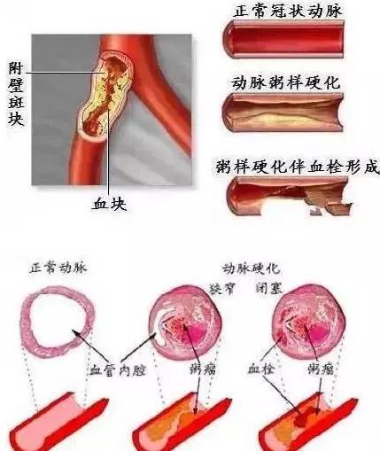 血管是如何一天天堵塞的，看完吓一跳