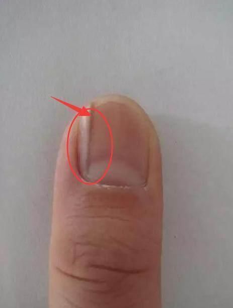 指甲上出现这几种竖纹? 那你要注意, 多吃这些
