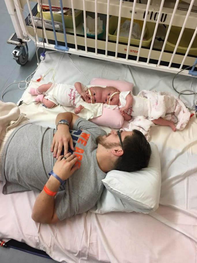 罕见连体婴头部相连 30余医护花11小时成功分离