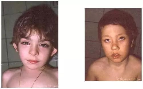 图片来源于网络:歌舞伎面谱综合征患者 这类患者具有5个主要特征