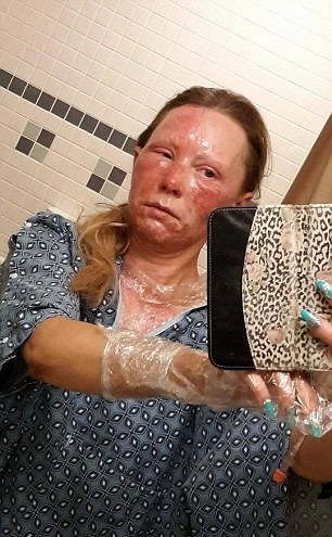 北爱尔兰钢管舞演员秀喷火绝技 脸部遭严重烧伤