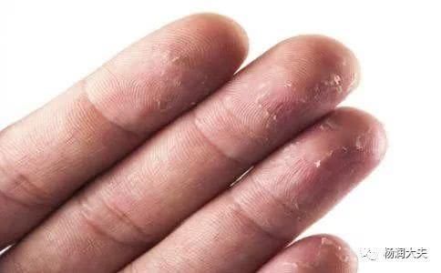 手,小李的双手又到了脱皮的季节,手脚干燥性脱