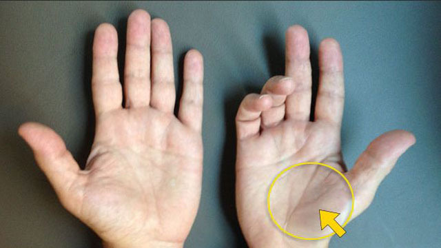 大小鱼际肌萎缩可能是糖尿病惹的祸 大小鱼际肌萎缩可能是糖尿病惹的祸