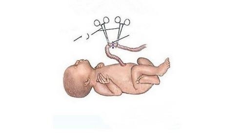 新生儿脐带怎么护理?消毒步骤要牢记