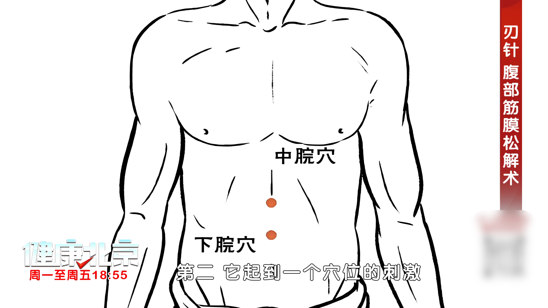 认针松解腹筋膜，脾胃腰疾双调理