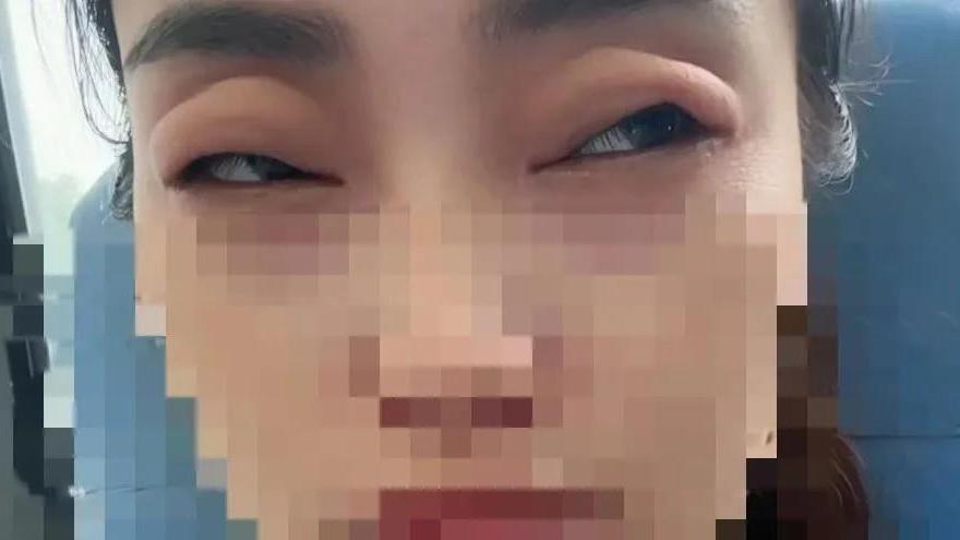 女子吃了两颗杨梅秒变“悲伤蛙” 医生：“罕见却凶险”