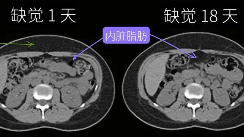 注意！缺觉，可能会让你加速变胖