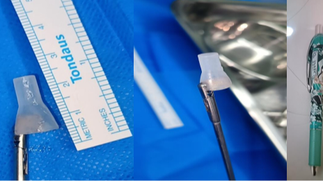 9岁男童误吸“封闭笔帽”致严重气压伤,医生连夜手术成功取出 9岁男童误吸“封闭笔帽”致严重气压伤,医生连夜手术成功取出