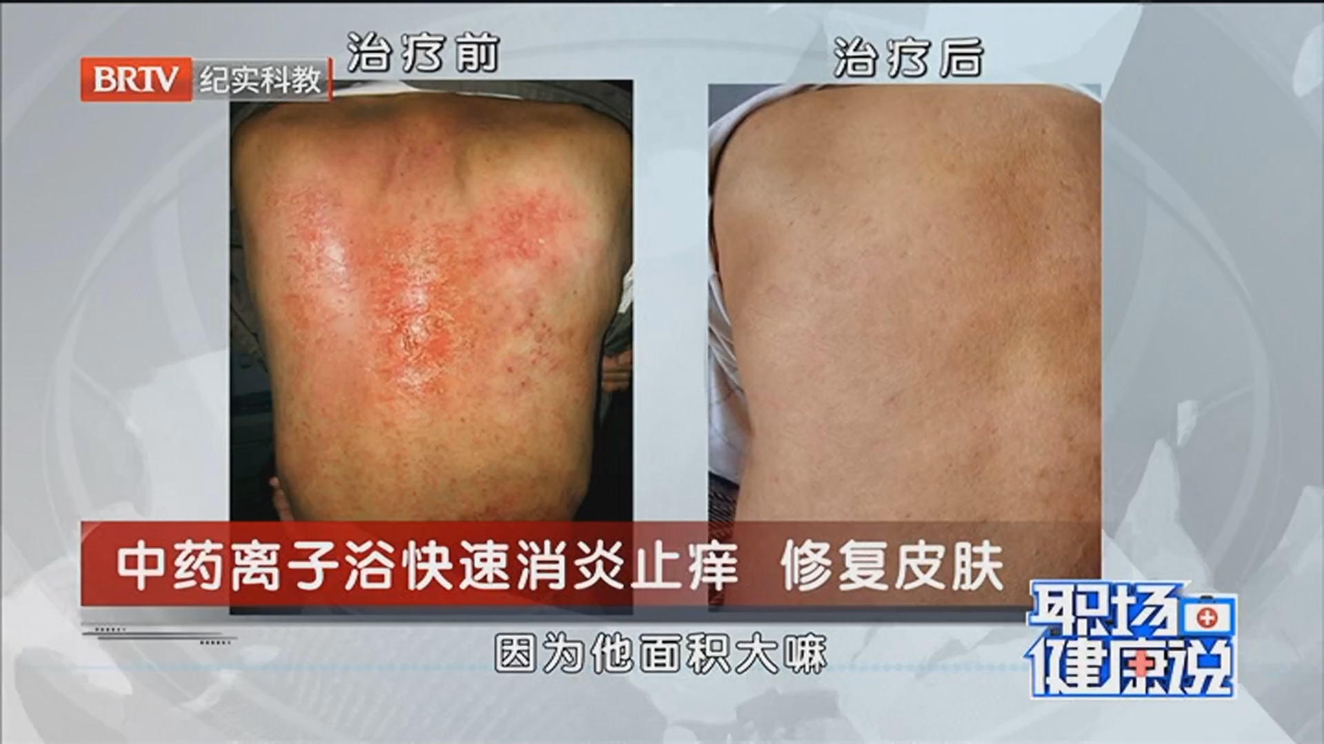 《职场健康说》20260618摆脱湿疹 肌获新生
