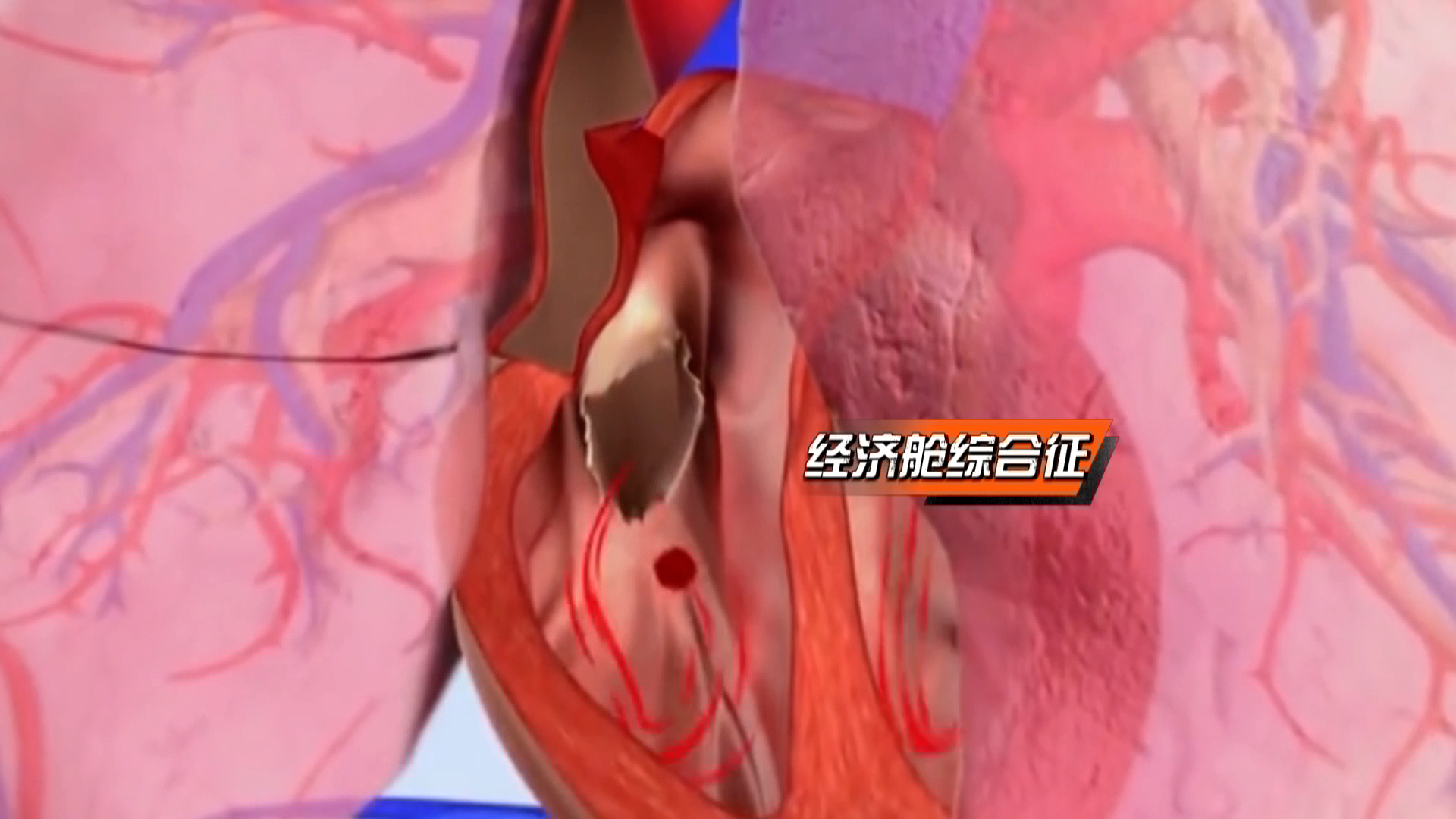 警惕“经济舱综合征”!久坐不动或危及生命! 警惕“经济舱综合征”!久坐不动或危及生命!