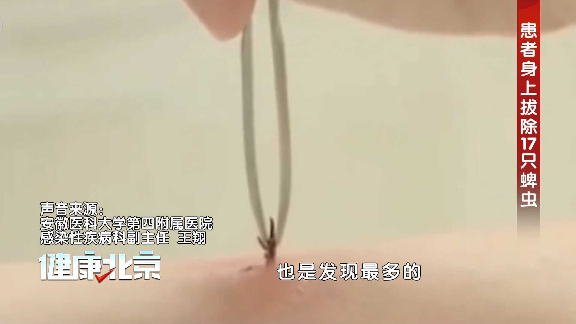山区活动患者持续发热，医生检查惊现17只蜱虫附体！