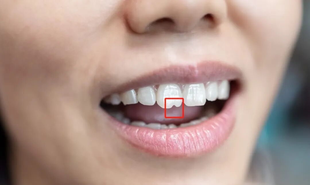 门牙前的“豁”真是嗑瓜子惹的祸?多年来的困惑终于解开了! 门牙前的“豁”真是嗑瓜子惹的祸?多年来的困惑终于解开了!