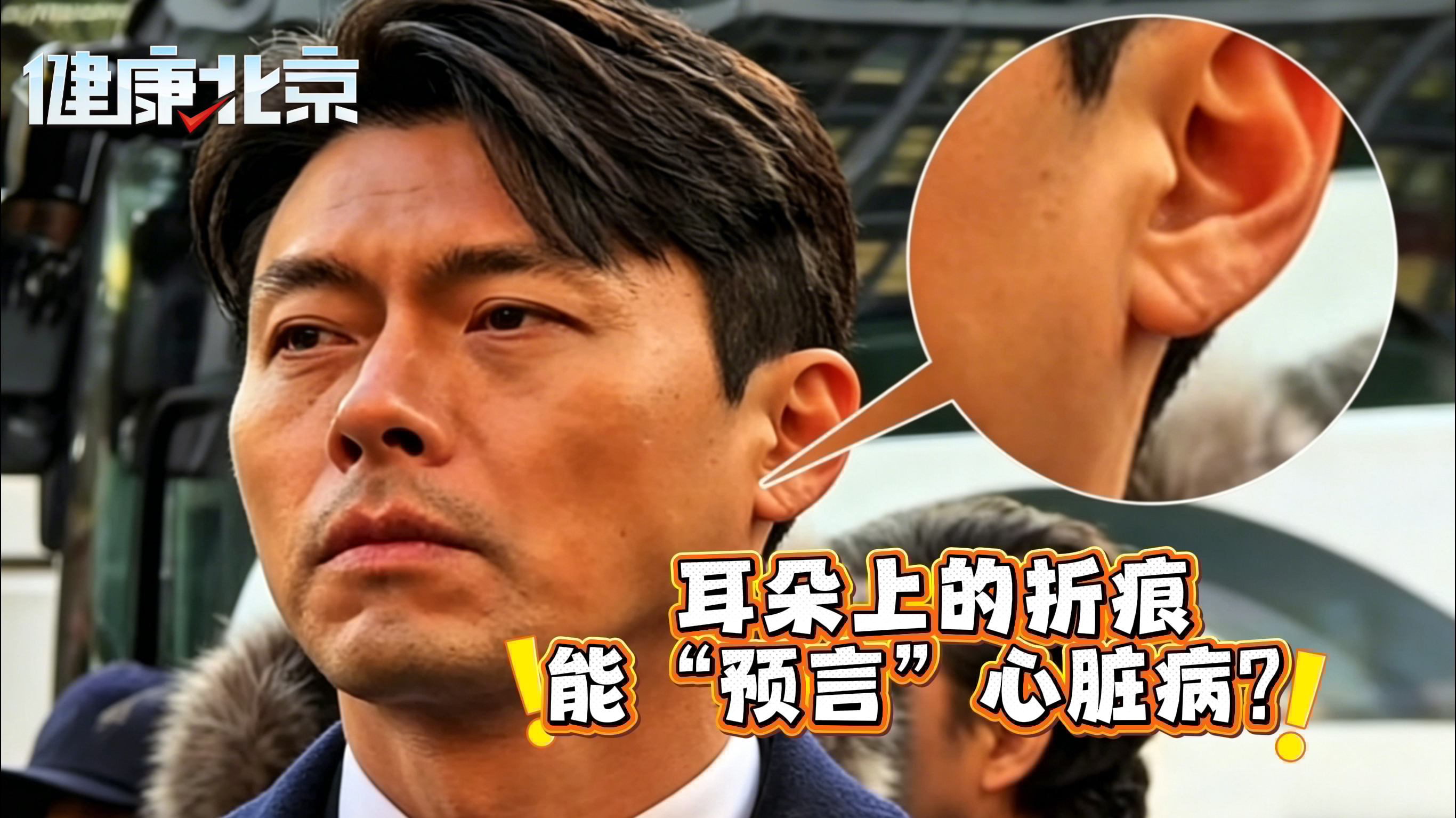 耳朵上的折痕,能“预言”心脏病? 耳朵上的折痕,能“预言”心脏病?