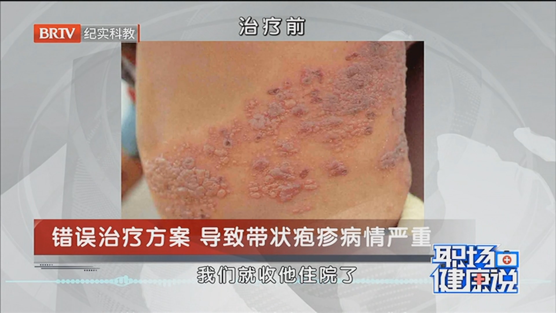 《职场健康说》20260610难以言说的痛 带状疱疹