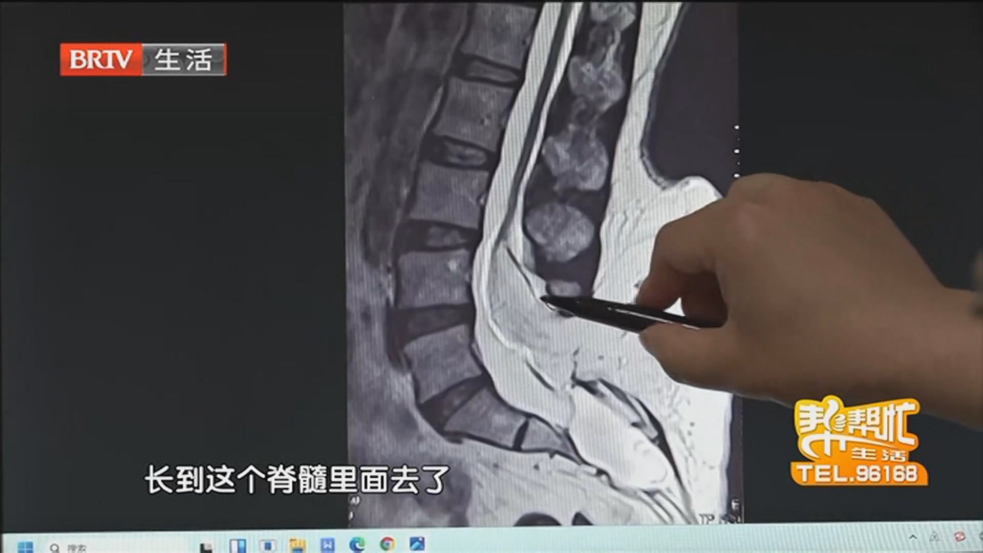 女孩排尿难备受折磨 元凶竟是后腰小鼓包