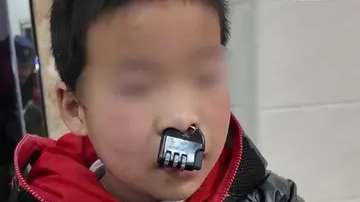 儿童玩密码“锁”卡住鼻子，家长求助消防员