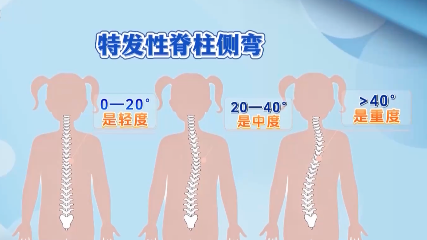孩子高低肩、总喊腰酸背痛？可能是脊柱侧弯