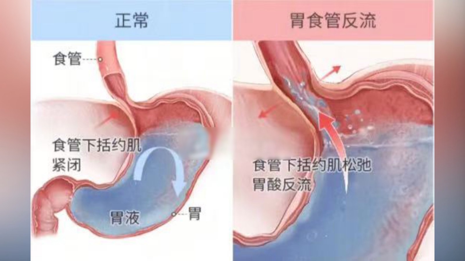 每天“奶茶续命” 小心胃食管反流_北京时间