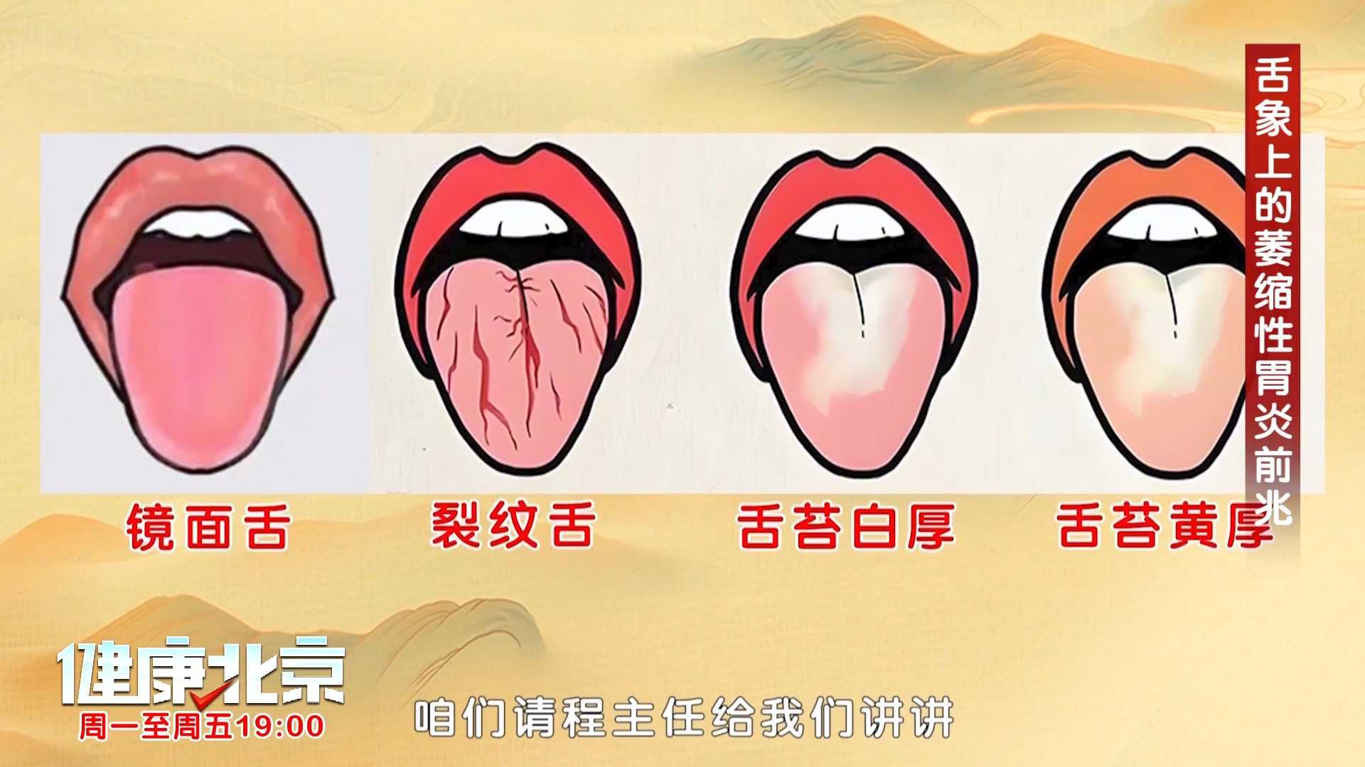 萎缩性胃炎的舌象预警,快对照看看你的舌头吧! 萎缩性胃炎的舌象预警,快对照看看你的舌头吧!