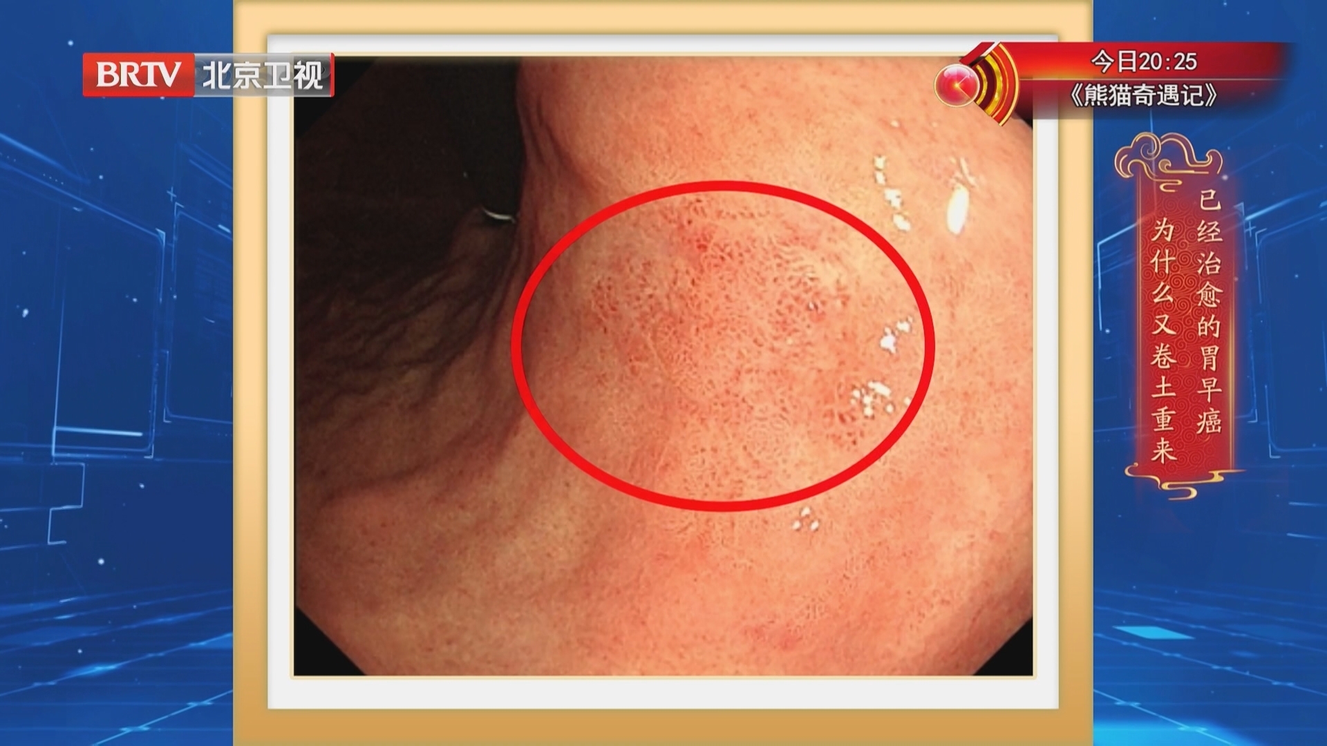 《养生堂》20251128浇错水就发芽的胃中“癌种子”