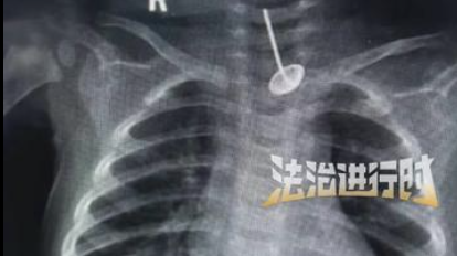 婴儿误食鞭炮嘴巴被炸伤 送医后发现食管内还有一颗钉子 婴儿误食鞭炮嘴巴被炸伤 送医后发现食管内还有一颗钉子