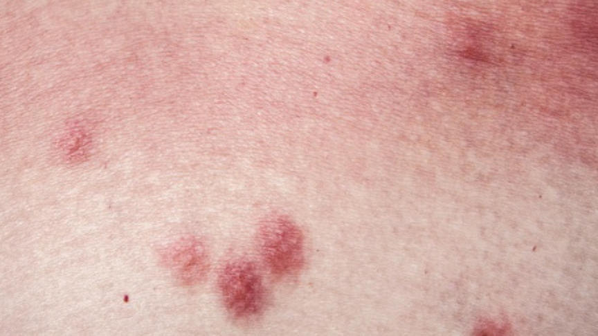 严重或危及生命!被虫咬伤后如何正确处理?牢记这几点→ 严重或危及生命!被虫咬伤后如何正确处理?牢记这几点→