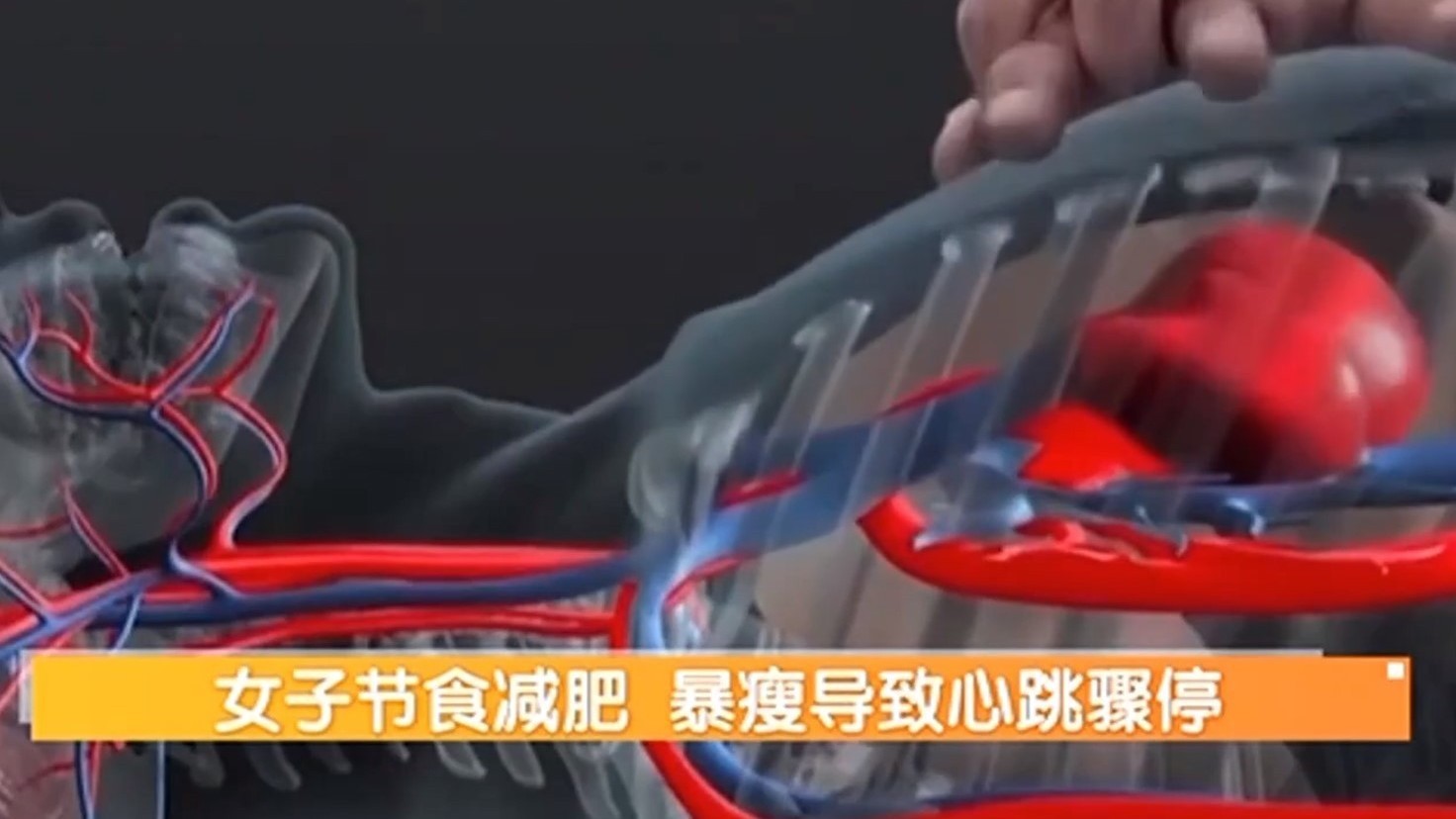 女子减肥过度导致心跳骤停