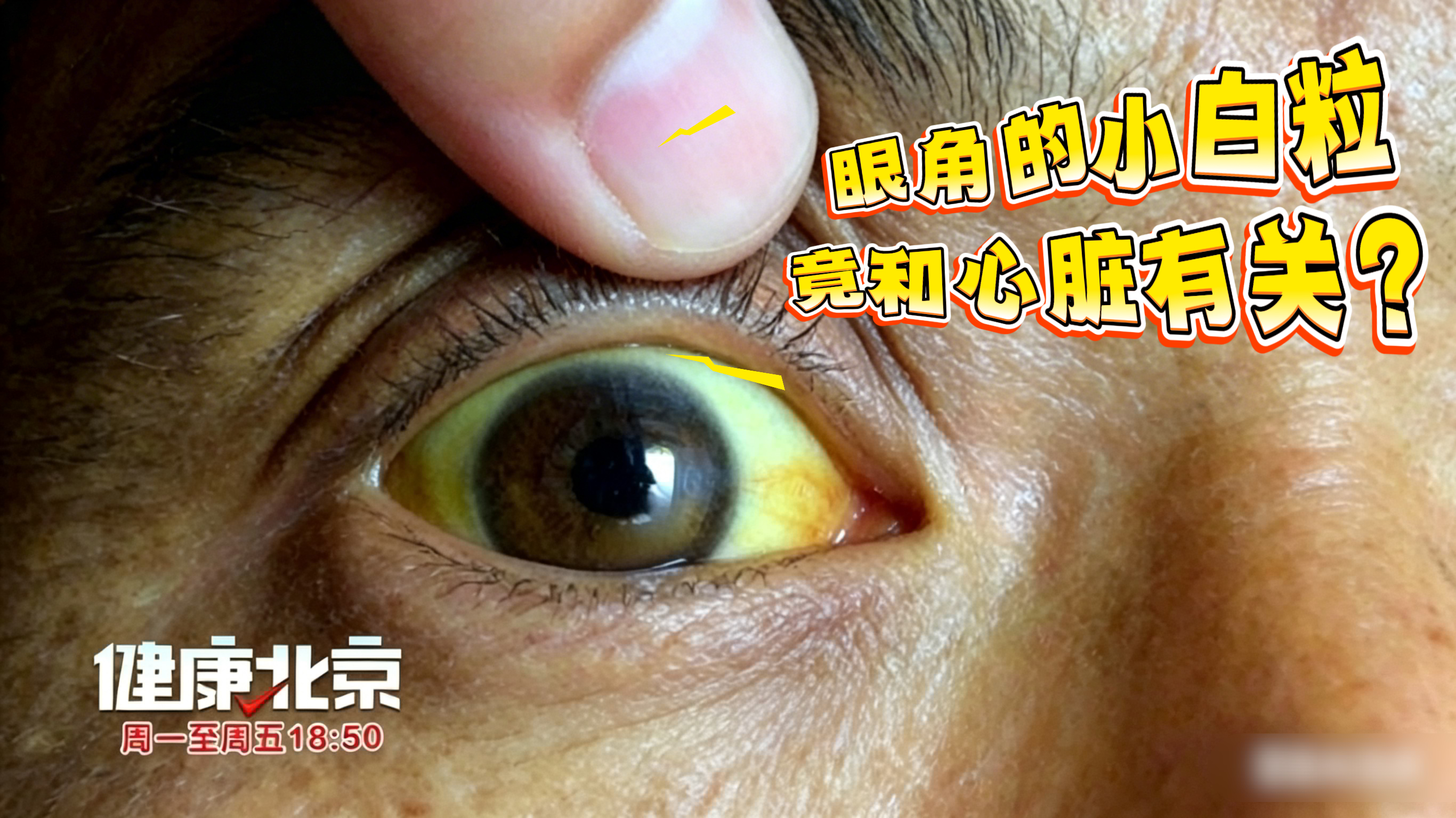 眼角的小白粒，竟和心脏有关？即可8解密卡，居民和n'b