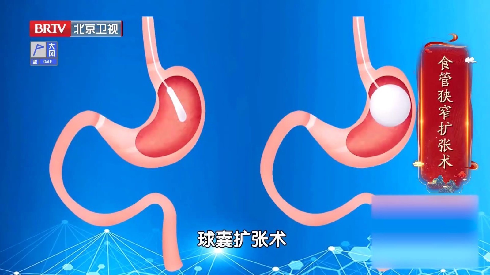 高龄老人也能做食管狭窄扩张术，内镜微创，治疗疾病，提高生活质量！_北京时间
