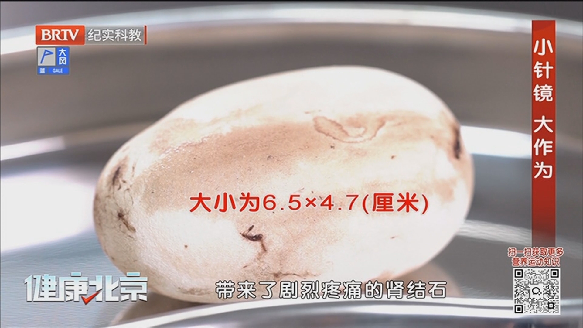 《健康北京》20250422小针镜 大作为 《健康北京》20250422小针镜 大作为