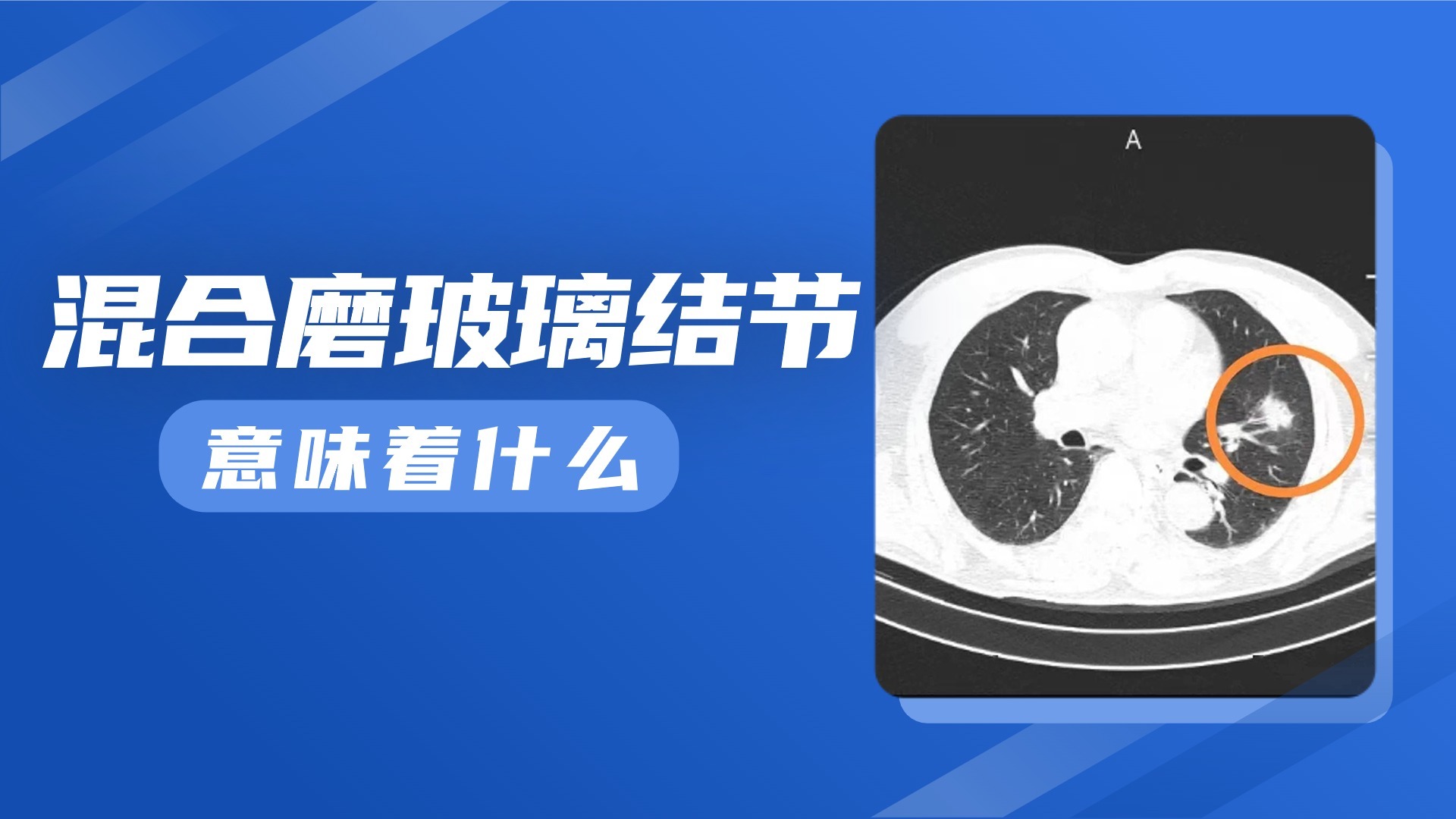混合磨玻璃结节意味着什么? 混合磨玻璃结节意味着什么?