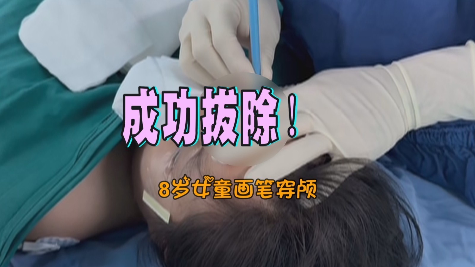 8岁女童画笔穿颅 同仁医院成功拔除