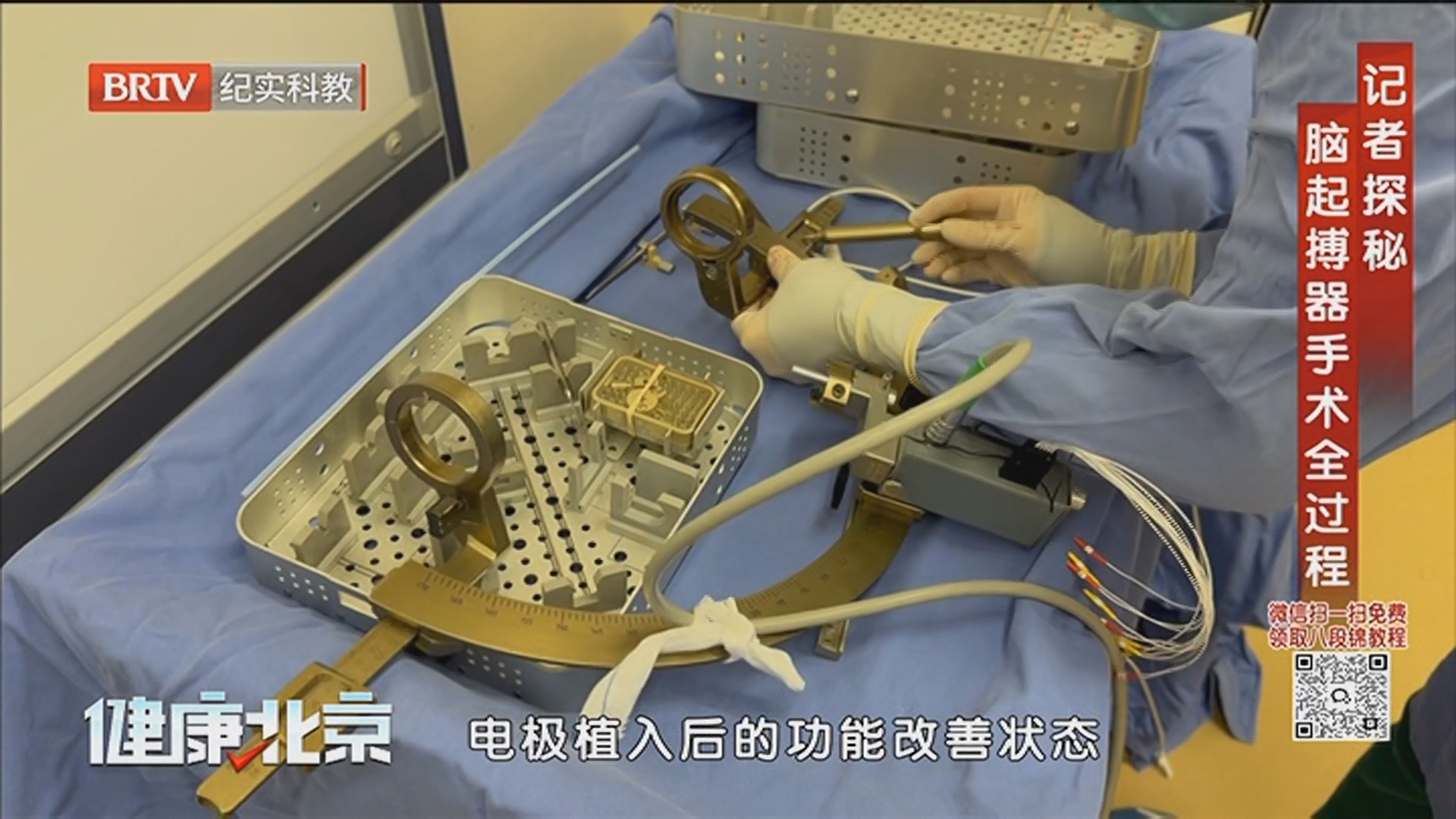 《健康北京》20241231记者探秘 脑起搏器手术全过程 《健康北京》20241231记者探秘 脑起搏器手术全过程