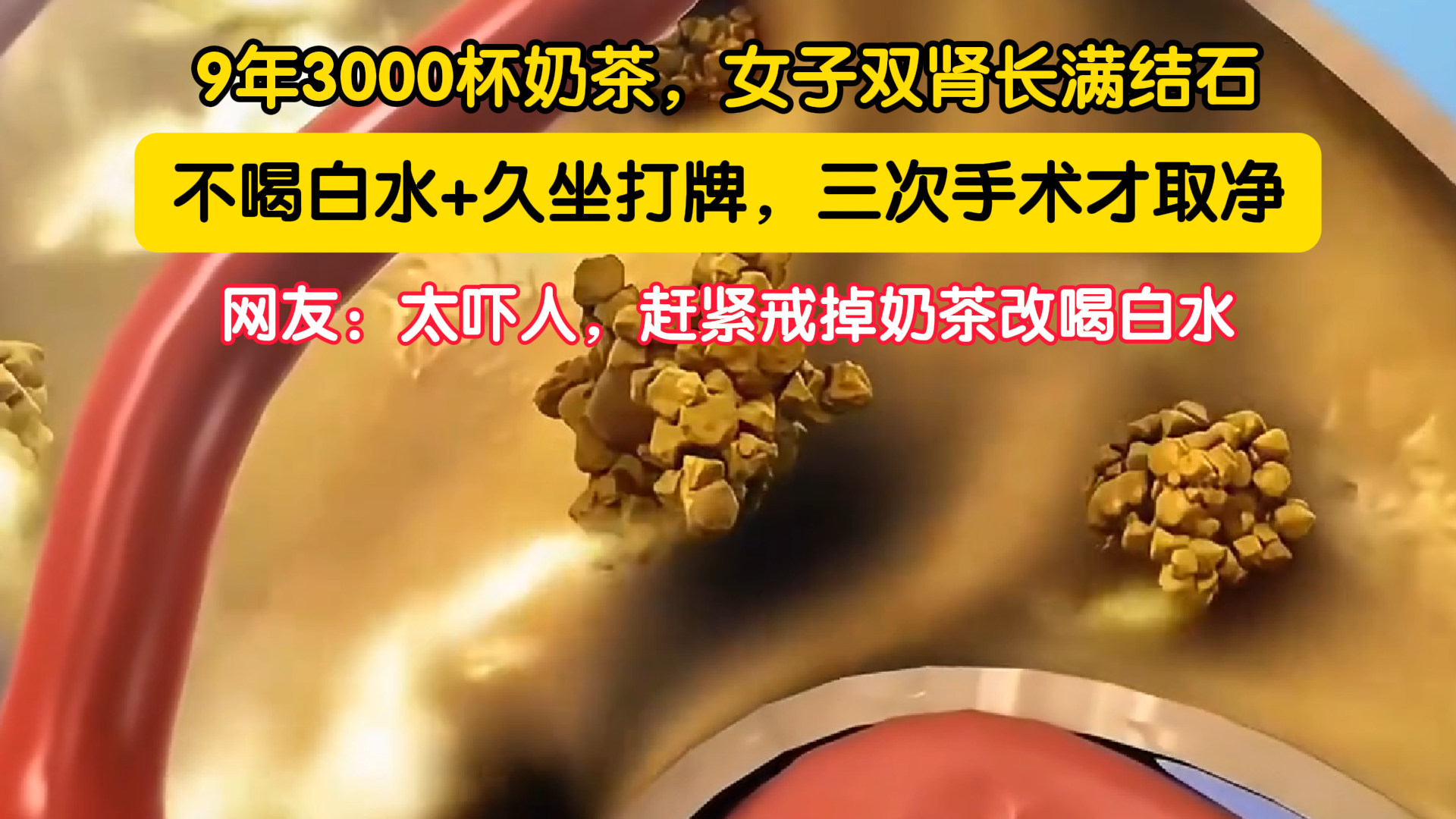 9年3000杯奶茶,女子双肾长满结石 9年3000杯奶茶,女子双肾长满结石