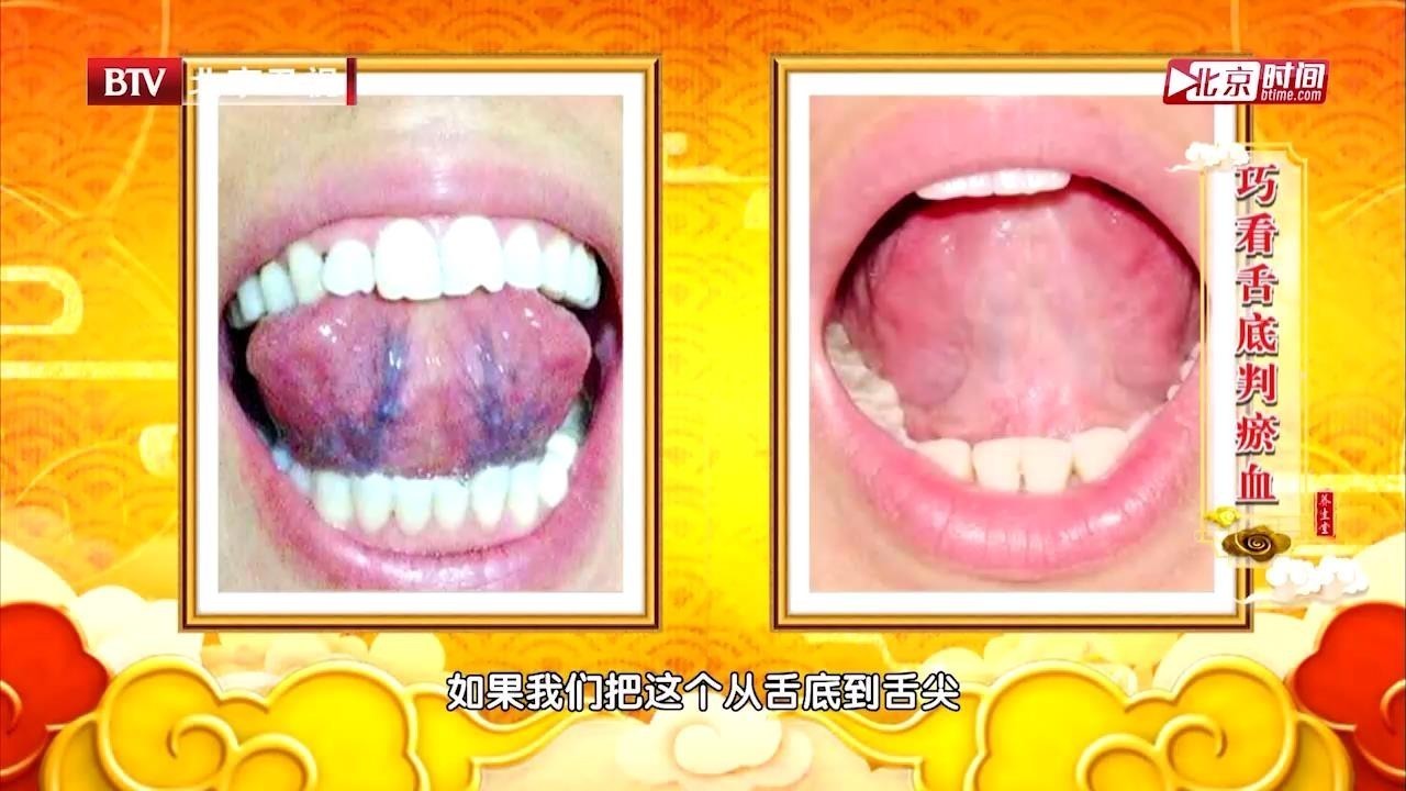 专家现场教您如何看舌底，来判断自己是否有瘀血_北京时间