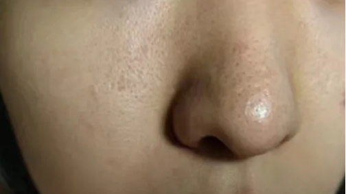 糖化脸和吃糖是什么关系